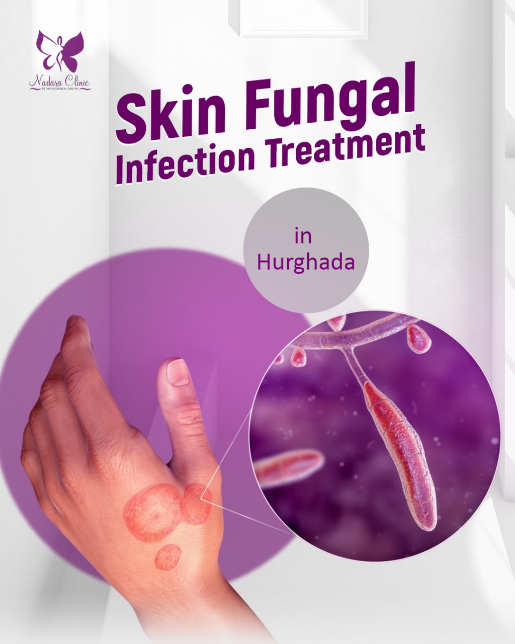 Skin fungal treatment in Hurghada